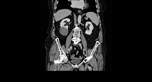 CT pelvic scan