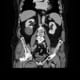 CT pelvic scan