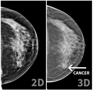 detecting breast cancer 3D mammography