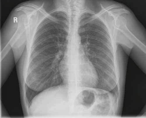 Healthy Lung Pictures X Ray