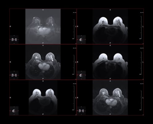 breast MRI scans