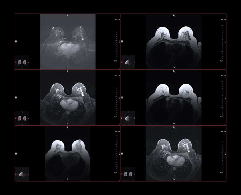 Breast MRI | Radiology of Indiana