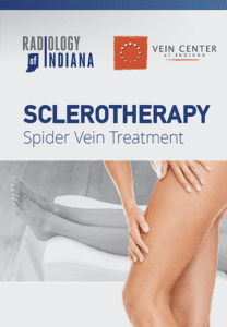 treatment for spider veins radiology brochure