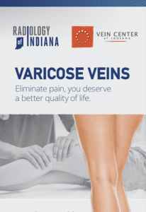 treatment for varicose veins radiology brochure