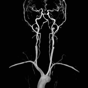 carotid arteries MRI scan