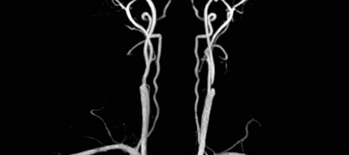 carotid arteries MRI scan
