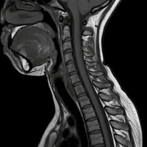 cervical spine MRI scan