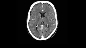 CT brain scan