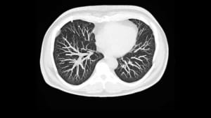 CT kidney scan