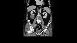 CT pelvic scan