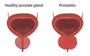 Enlarged prostate (1)