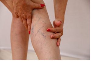 Zoomed in shot of woman with varicose veins.